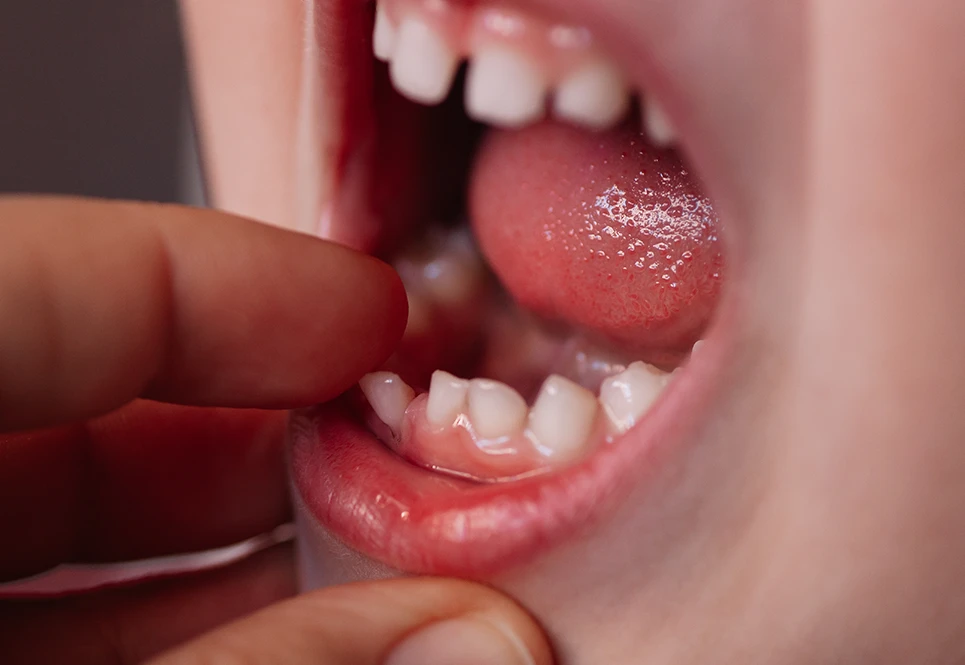 Closeup shot of toddler’s mouth open with a loose tooth inside.