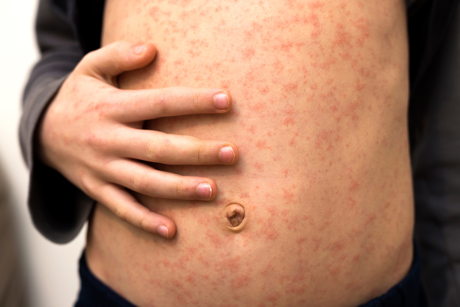 Young child's abdomen with an outbreak of measles