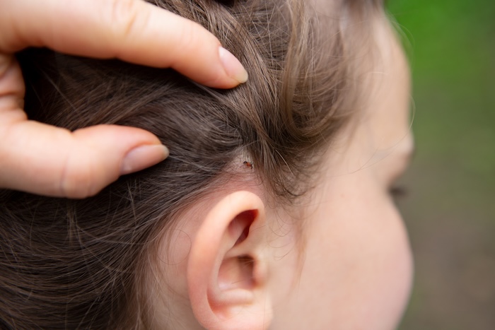 Closeup shot of a little girl with a tick behind her ear. 